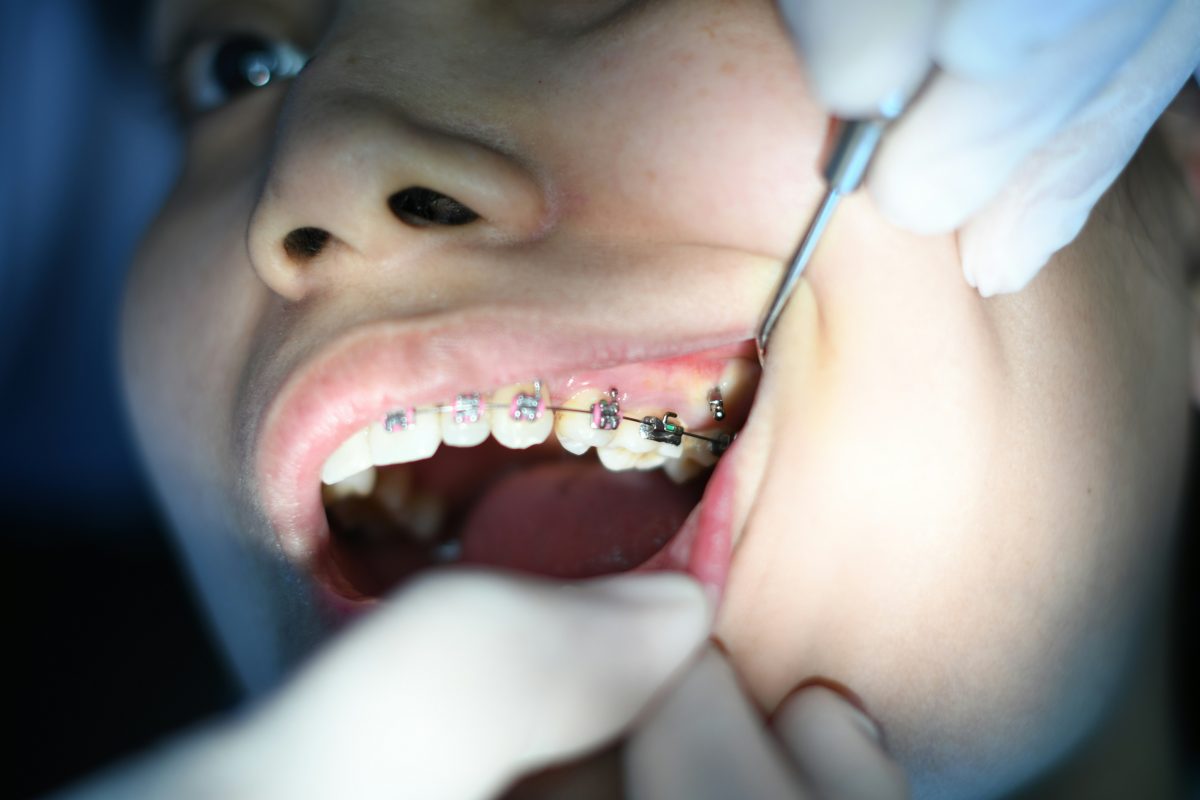 Clear Aligners